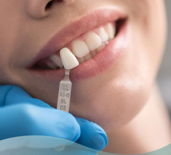 Faccette Dentali