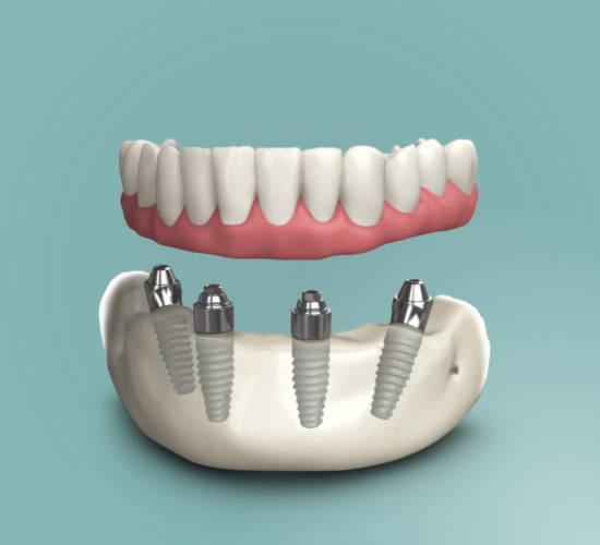 Impianti Dentali