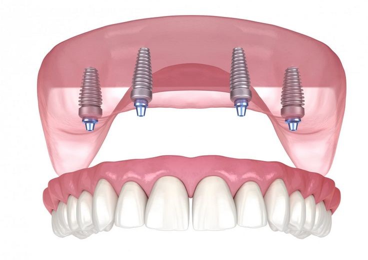 Quanto durano gli impianti All-on-4? 